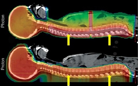 Particle Physics in Medicine: Targeting Cancer with Ion Beams