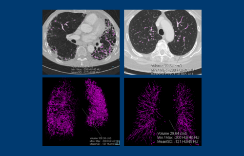 New research aims to identify measurable markers of pulmonary lipid that may have utility as Idiopathic Pulmonary Fibrosis (IPF) biomarkers. 