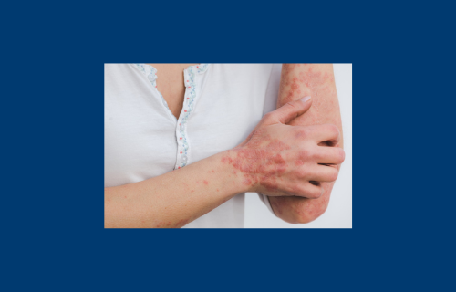 New study reveals signs of arthritis found in one in four psoriasis patients