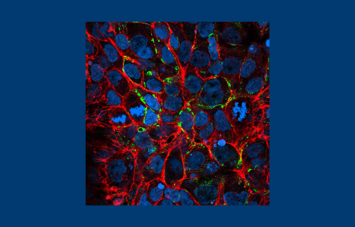 New research better understands how a person’s genetic makeup affects the progression of chronic kidney disease