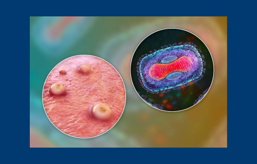 Irish experts lead international research alliance to tackle Mpox epidemic in Africa