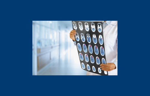 New pathways identified for stroke in people with atrial fibrillation