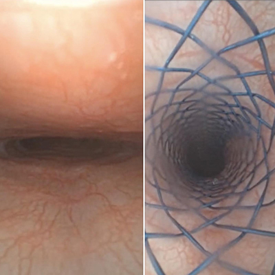 Images side by side of the trachea before the stent is inserted and the trachea after stent placement